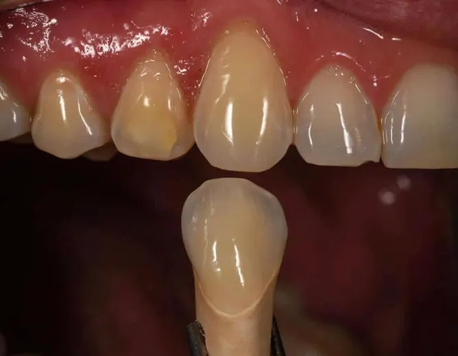 Estética anterior