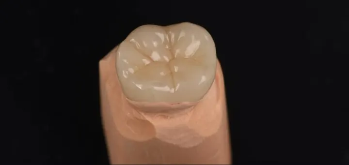 Corona molar monolítica