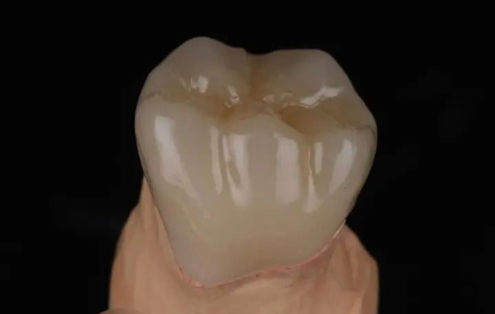 Corona posterior en zirconia