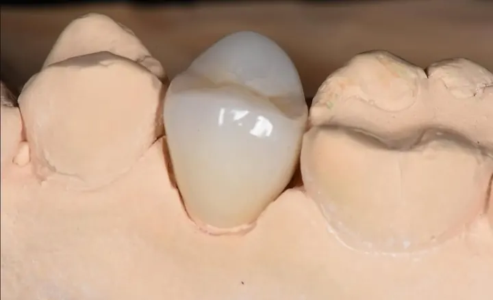 Corona unitaria en premolar