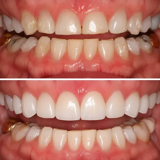 Antes y después