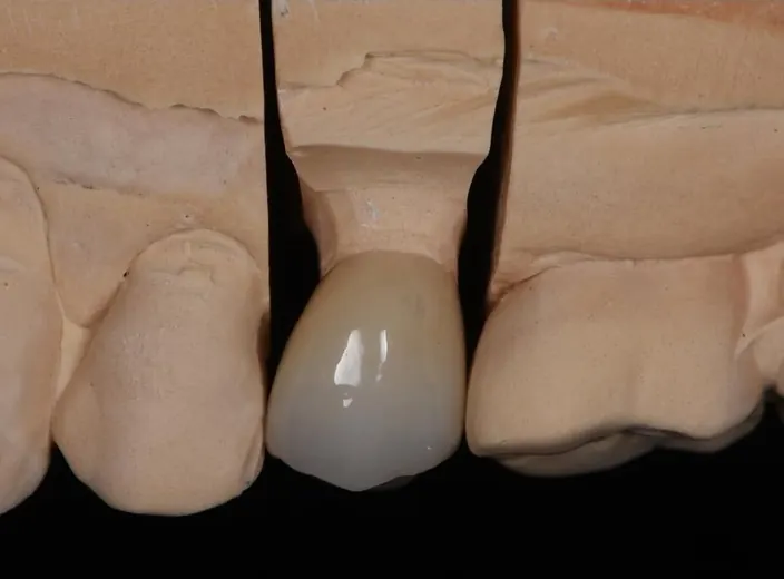 Corona anterior
