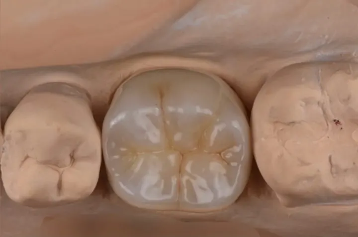 Anatomía oclusal detallada
