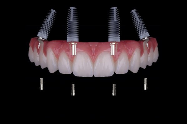 Rehabilitación completa sobre implantes